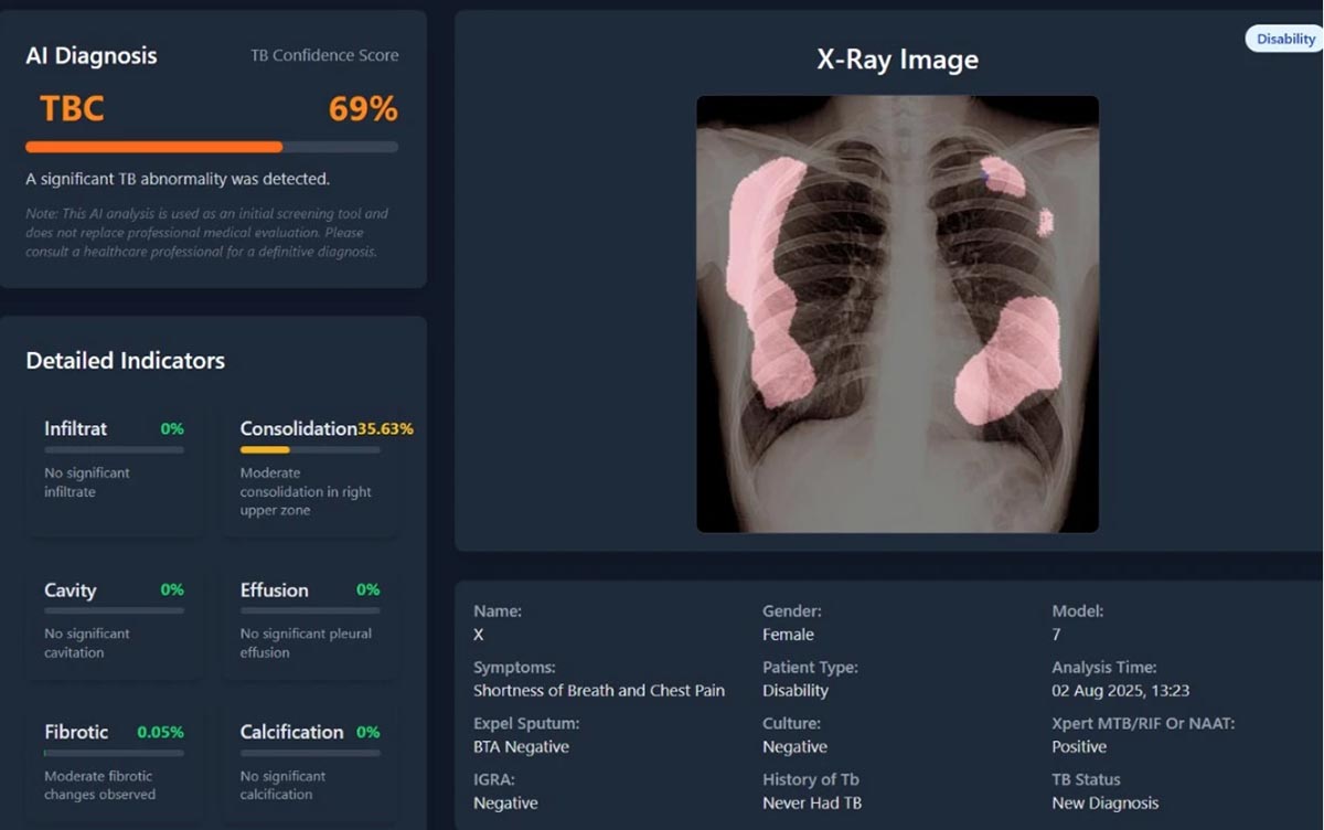 Guncang Dunia Medis, UGM Punya Senjata TBScreen.AI untuk Lawan TBC